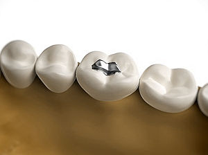 Empastes dentales metálicos de amalgamas de mercurio